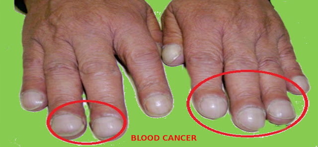 BLOOD CANCER